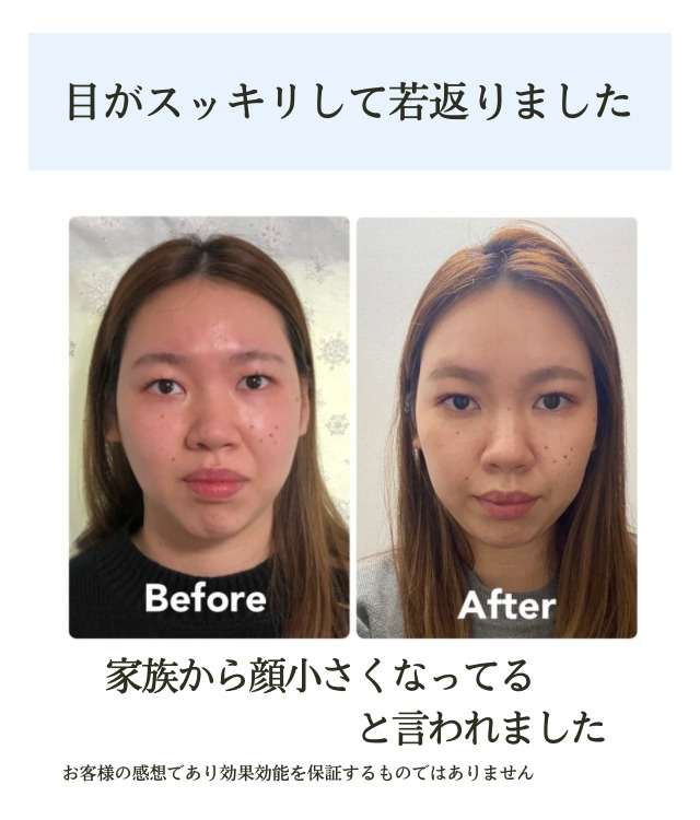 小顔矯正ビフォーアフター
