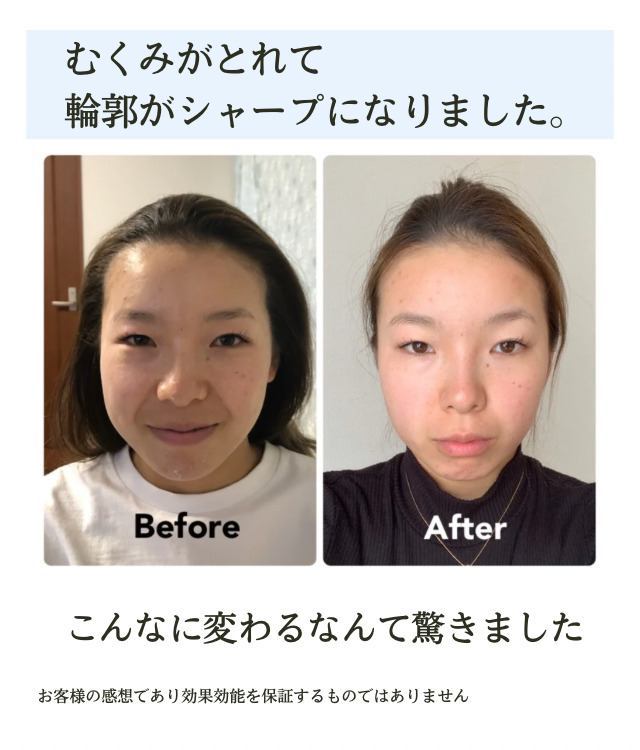 小顔矯正ビフォーアフター